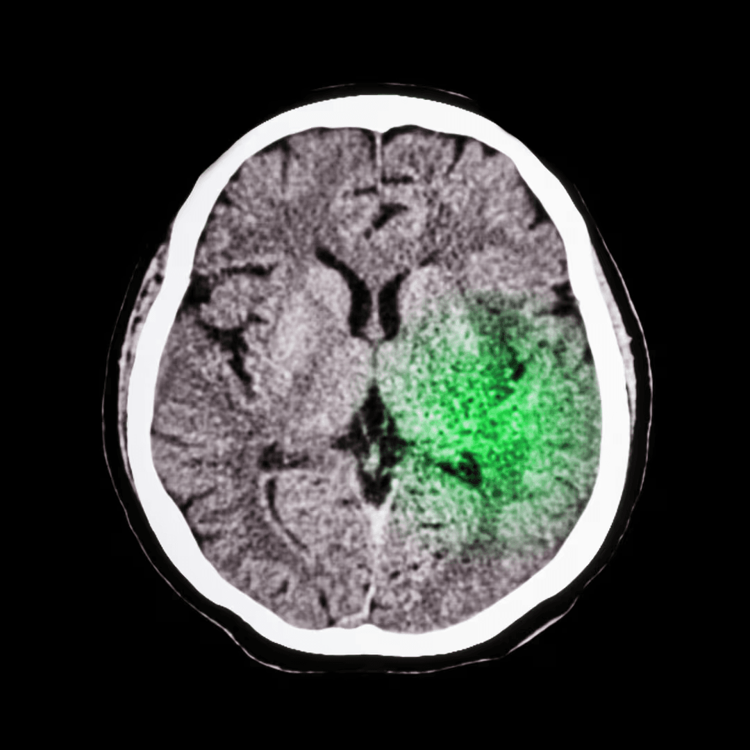 Illustration of the ischemic stroke mechanism